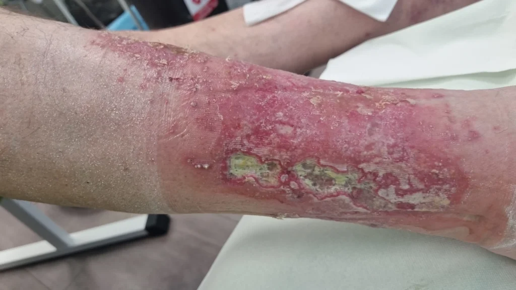 Rana przewlekła łydka 1