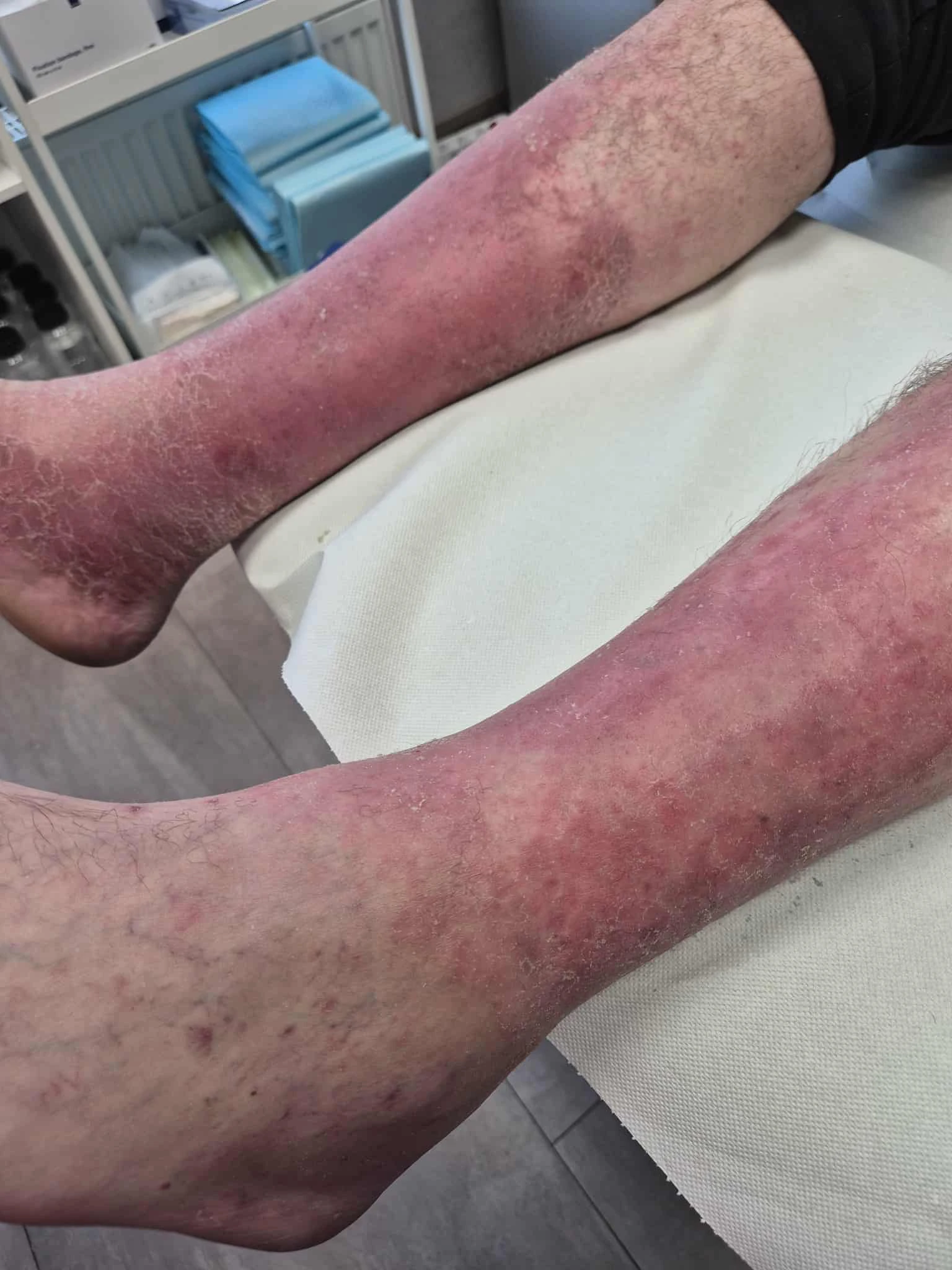 Rana przewlekła łydka 4