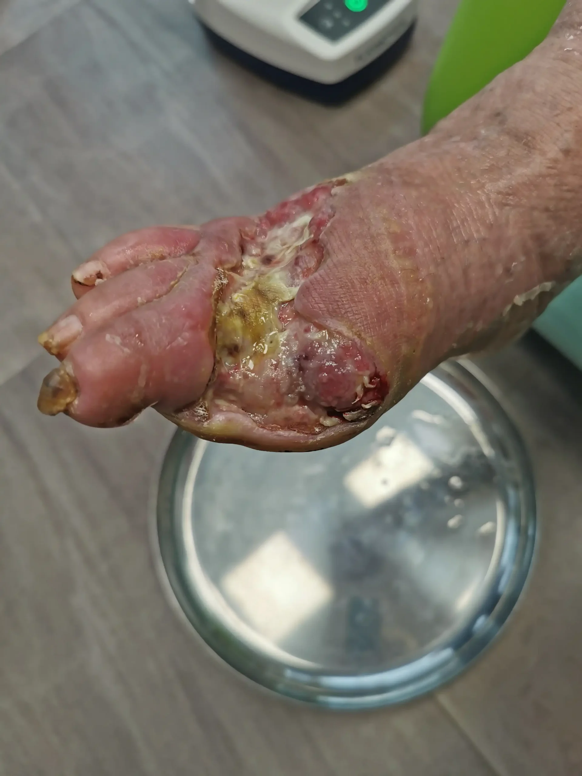 Rana przewlekła stopa 1