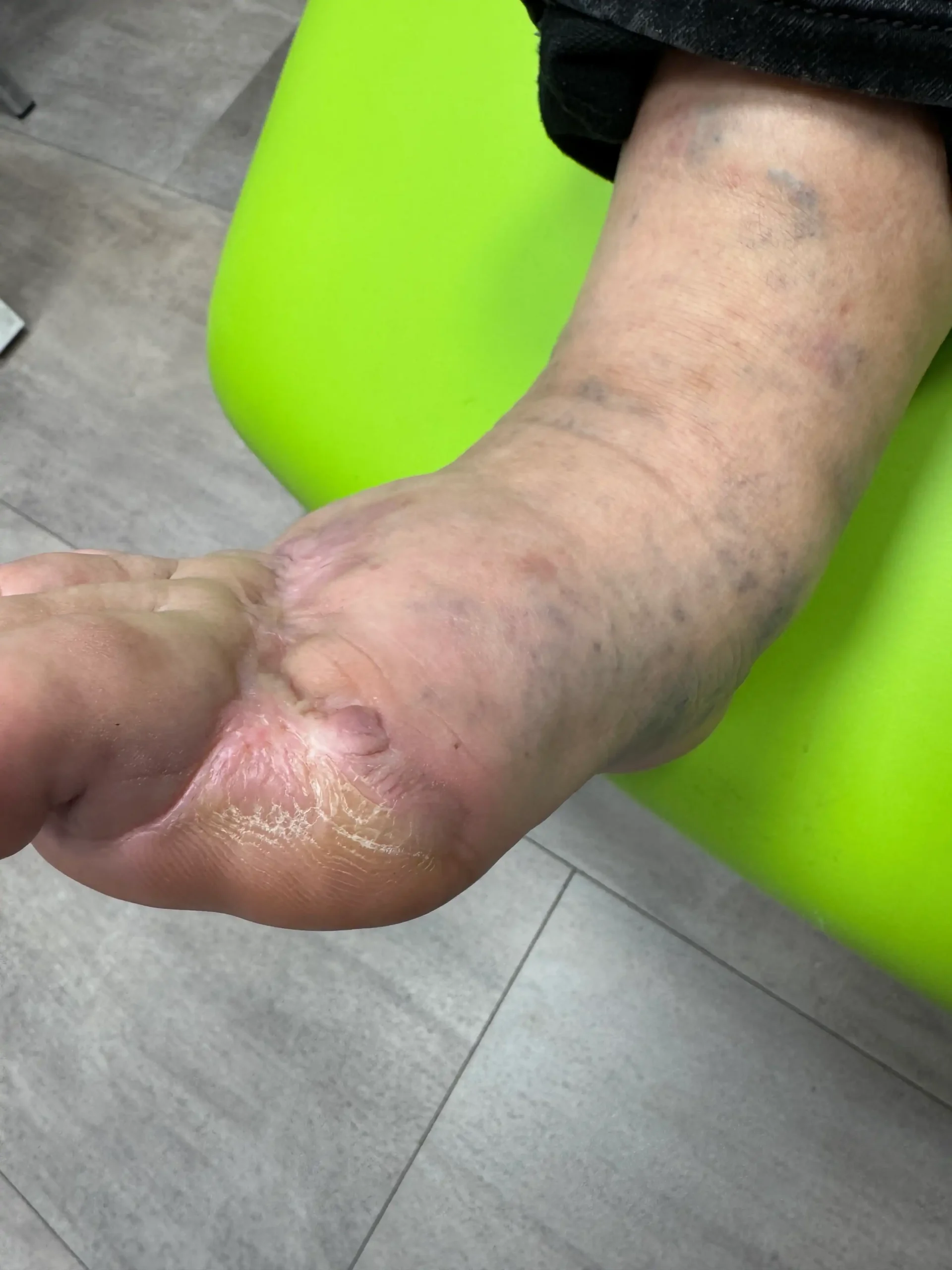 Rana przewlekła stopa 4